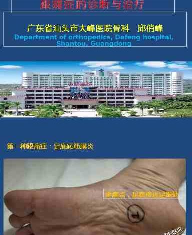跟痛症课件
